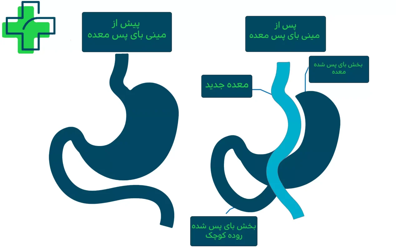 نحوه عمل بای پس معده